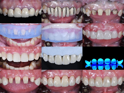 A.D.Dental Clinic ทำฟันรากเทียม อุดฟัน รากเทียม วีเนียร์ ถอนฟันคุด รักษาราก เดือย ครอบฟัน ทำฟันราม2 — photo 3